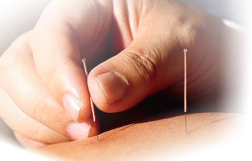 L’acupuncture c’est quoi?