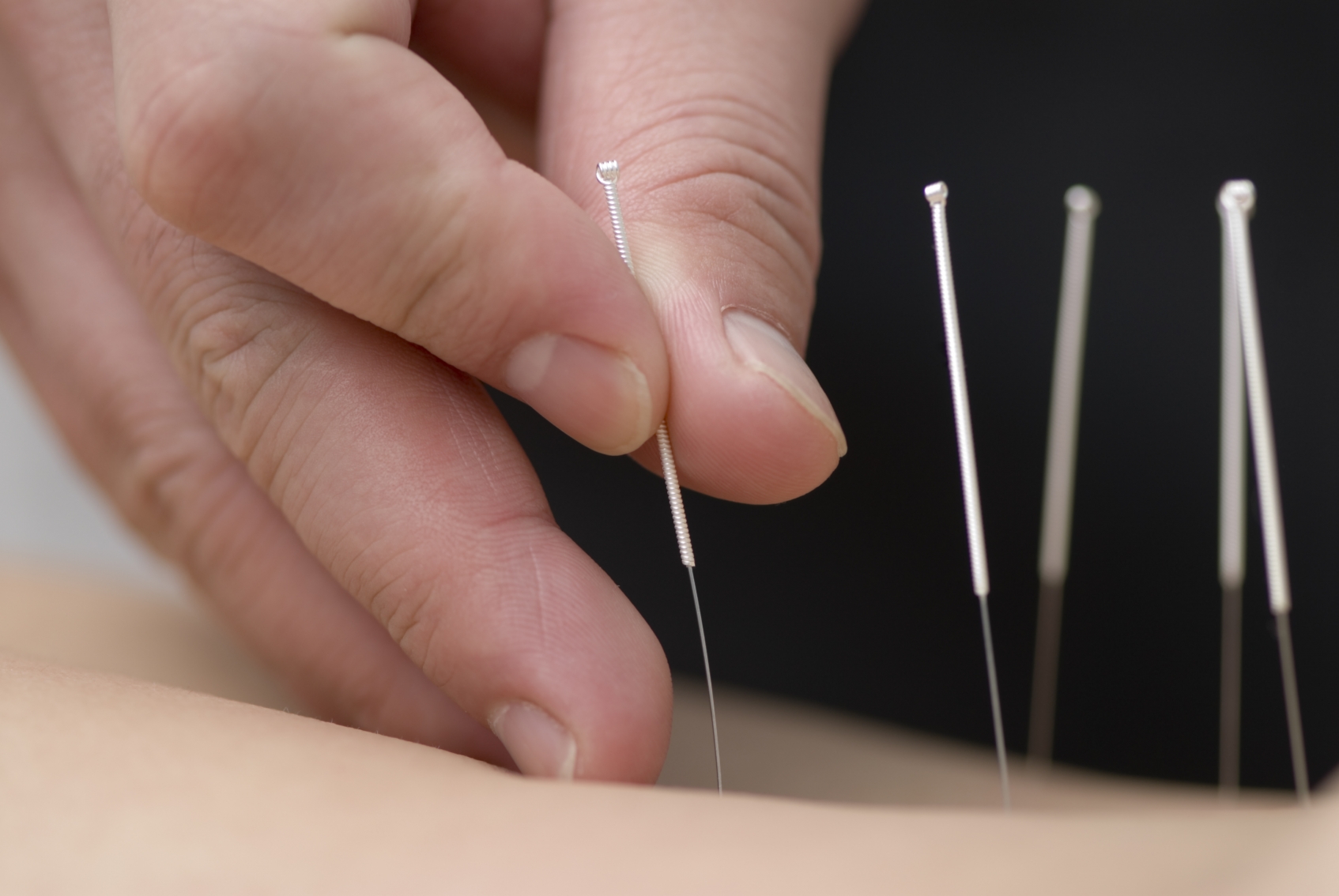 acupuncture-neo-bienetre