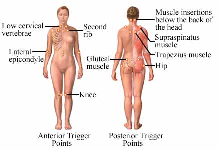 Médecine douce – Traitement de la fibromyalgie Avec Thérapie des Trigger points