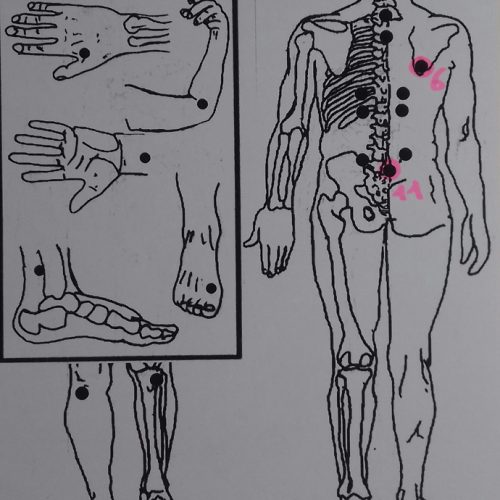 Hijama, médecine des ventouses, pour traiter la dépression et les problèmes psychiques