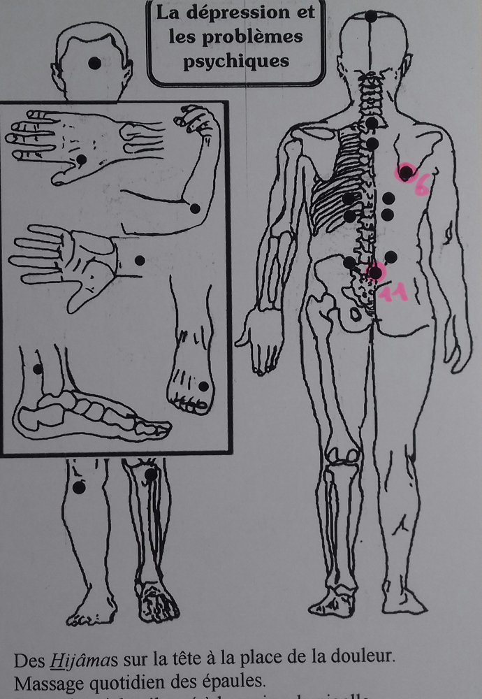 Livre - La Médecine des ventouses